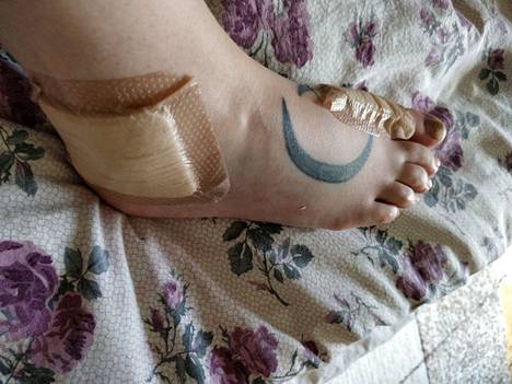 Kuvassa on Riikka Silenin turvonnut jalka, jonka hän loukkasi yli ajon yhteydessä. 