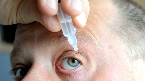 Kuivasilmäisyyden hoitoon käytetään silmätippoja, joita on lisättävä useita kertoja päivässä. 