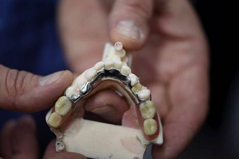 Hampaiden kokoproteesien tarve on vähentynyt Suomessa.