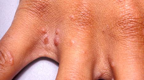 Tyypillisesti oireisia ihoalueita syyhyssä ovat esimerkiksi sormien välit.