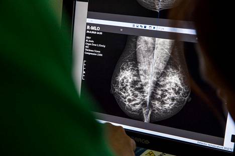 Rintoja tutkitaan esimerkiksi mammografian avulla. Kuvassa näkyy rintojen sisäosan rakenne.
