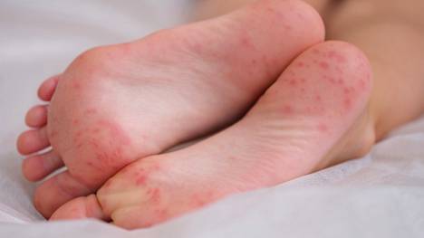 Enterorokko voi aiheuttaa jalkapohjiin rakkuloita. Lapsia rakkulat eivät yleensä haittaa, mutta aikuisilla ne voivat olla kovasti kutisevia.