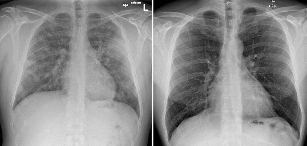 Koronaviruksen aiheuttama tauti aiheuttaa muutoksia keuhkoissa. Röntgenkuvassa vasemmalla koronapotilaan keuhkot ja verrokkina oikealla terveet keuhkot.  Kuvat ovat suomalaisesta sairaalasta, jonka nimeä ei julkaista potilaiden yksityisyyden suojaamiseksi. 