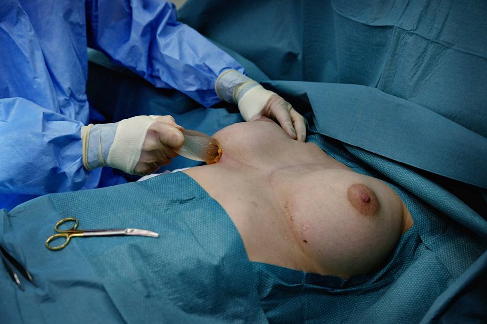 Plastiikkakirurgi Janne Jyränki vetää implantin ulos. Tämä tuntui Vilmasta vähän epämukavalta puudutuksesta huolimatta. 